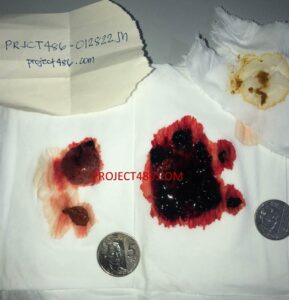 4 weeks embryo abortion in Cebu